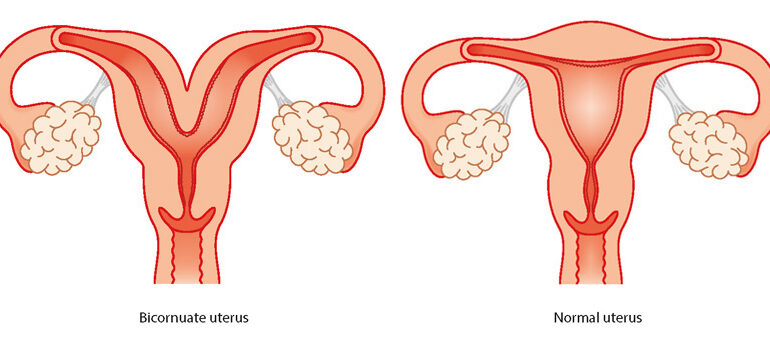 bicornuate uterus