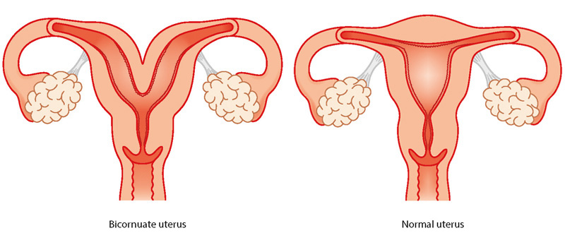 bicornuate uterus
