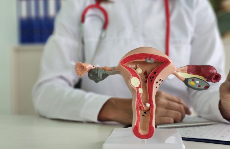 Ovarian Cyst