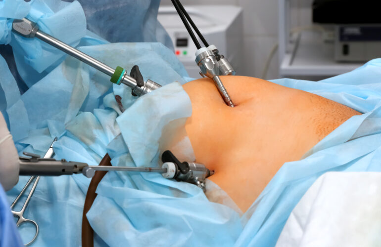 Gyneacologic Laparoscopy