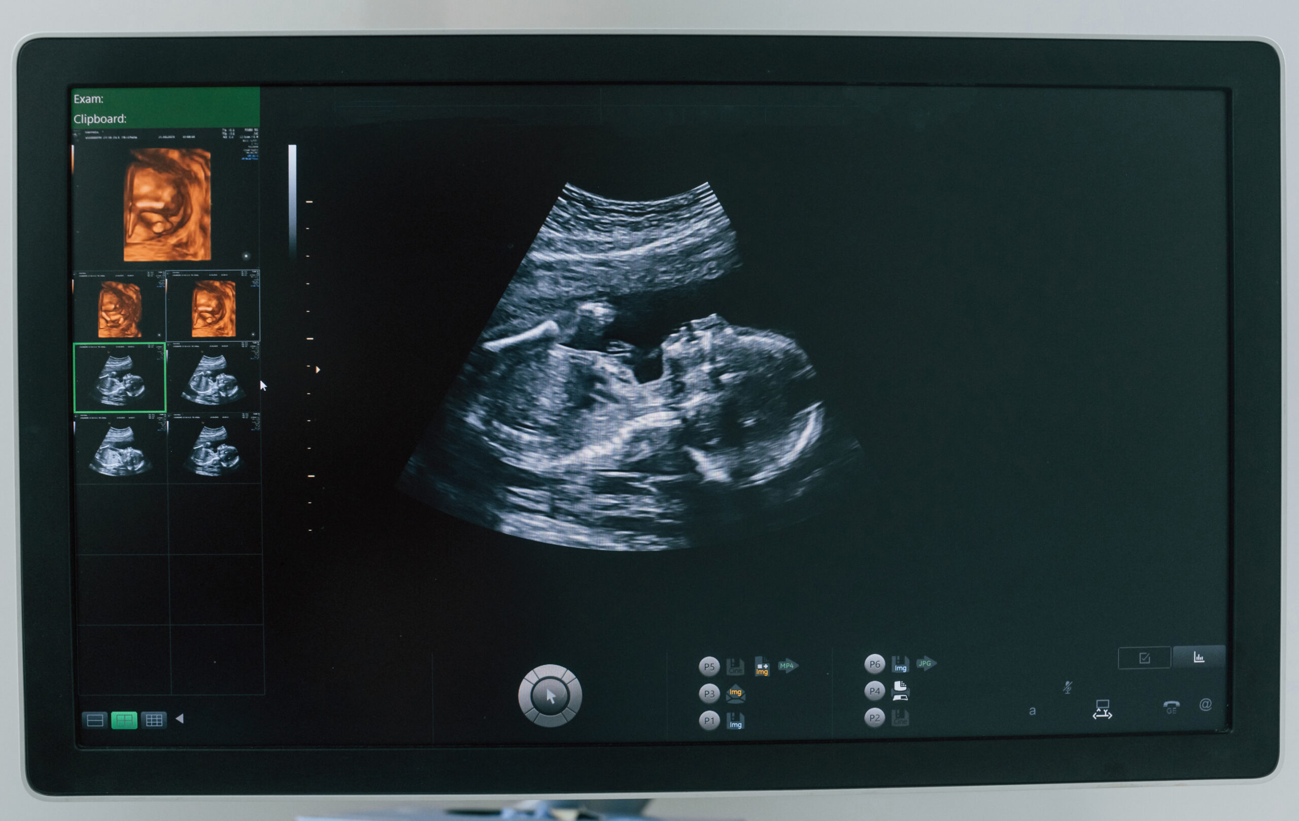 fetal echocardiography test
