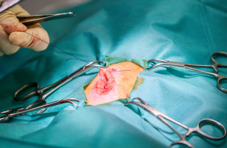 Hysteroscopic Surgery