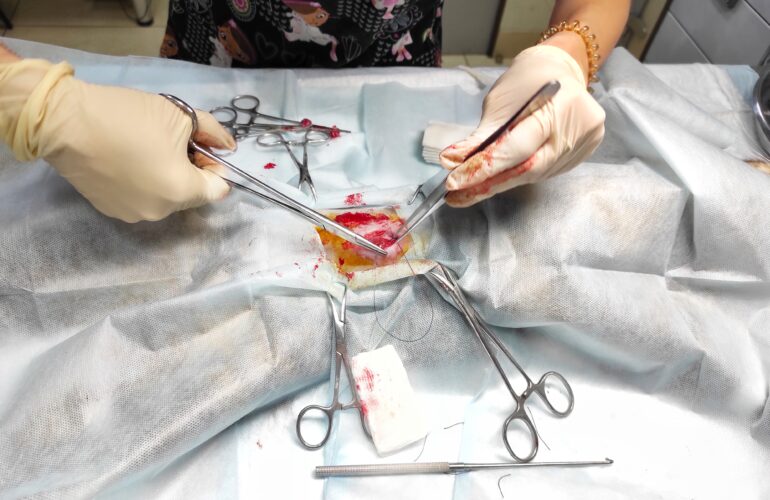 Laparoscopic Hysterectomy Surgery