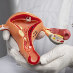 Laparoscopic ovarian cyst removal