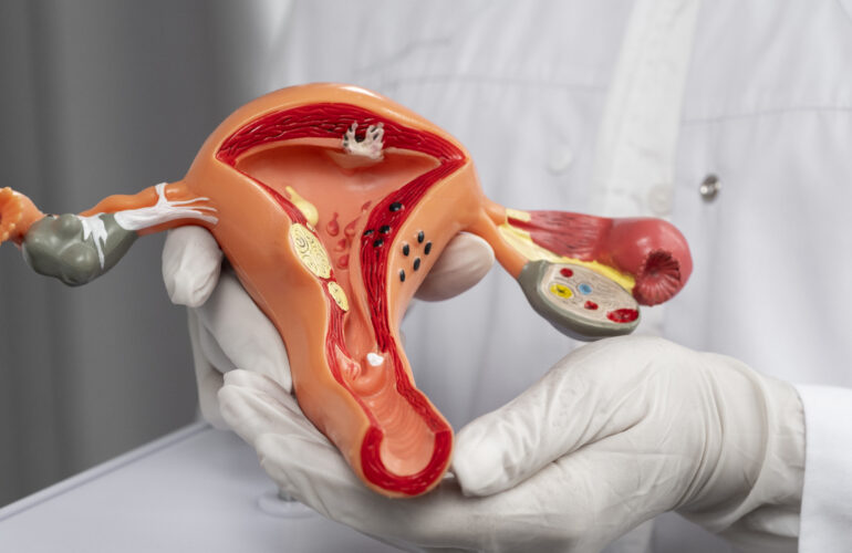 Laparoscopic ovarian cyst removal